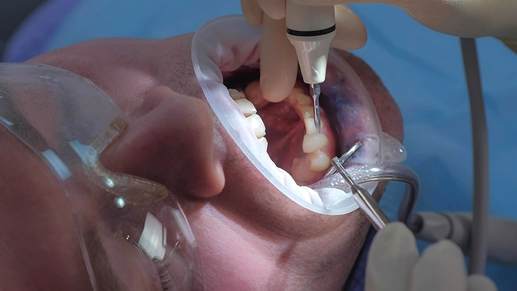 чистка зубного камня chistka-zubnogo-kamnya.jpg